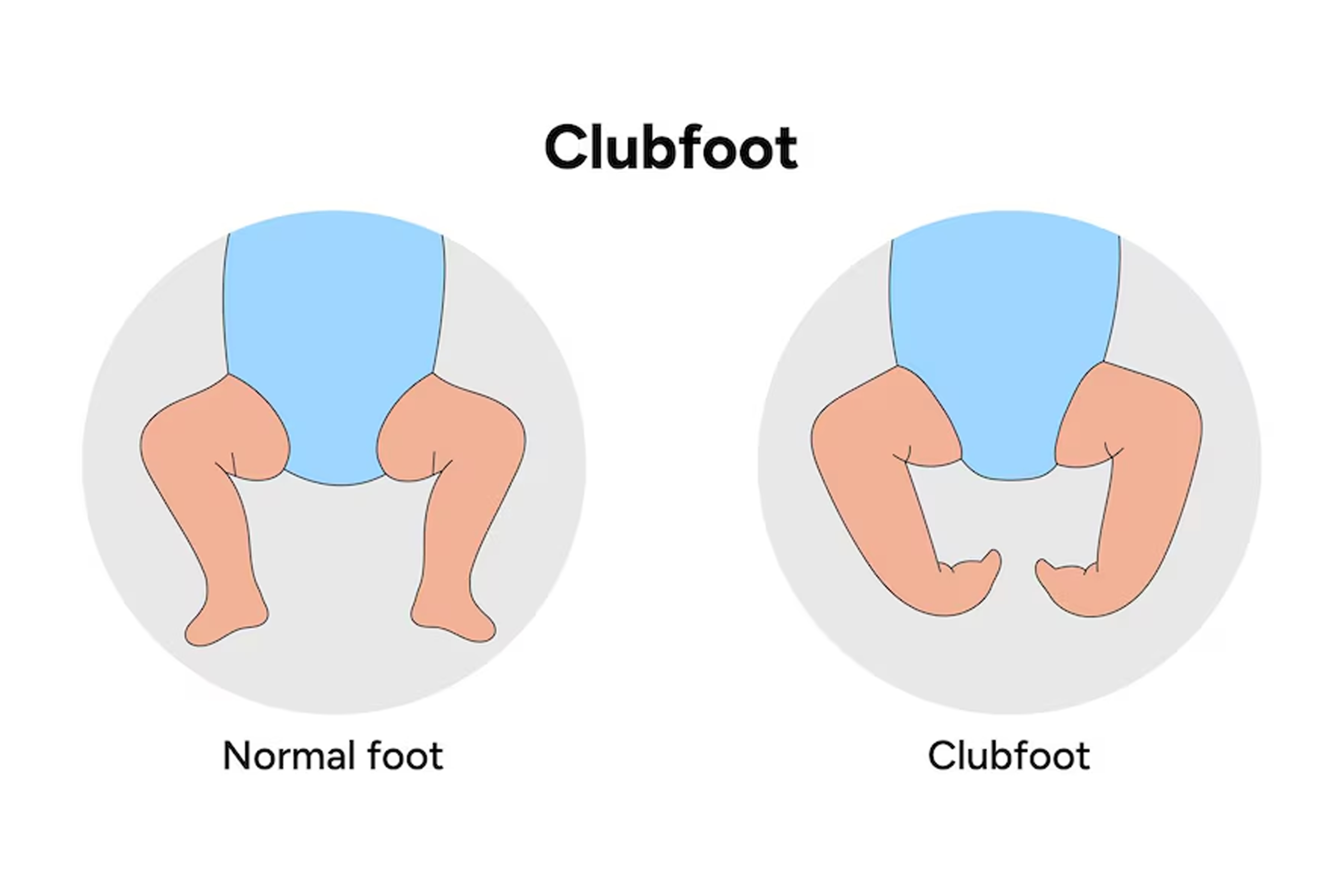 Straightening Foot in Newborns: Clubfoot Management & Treatment